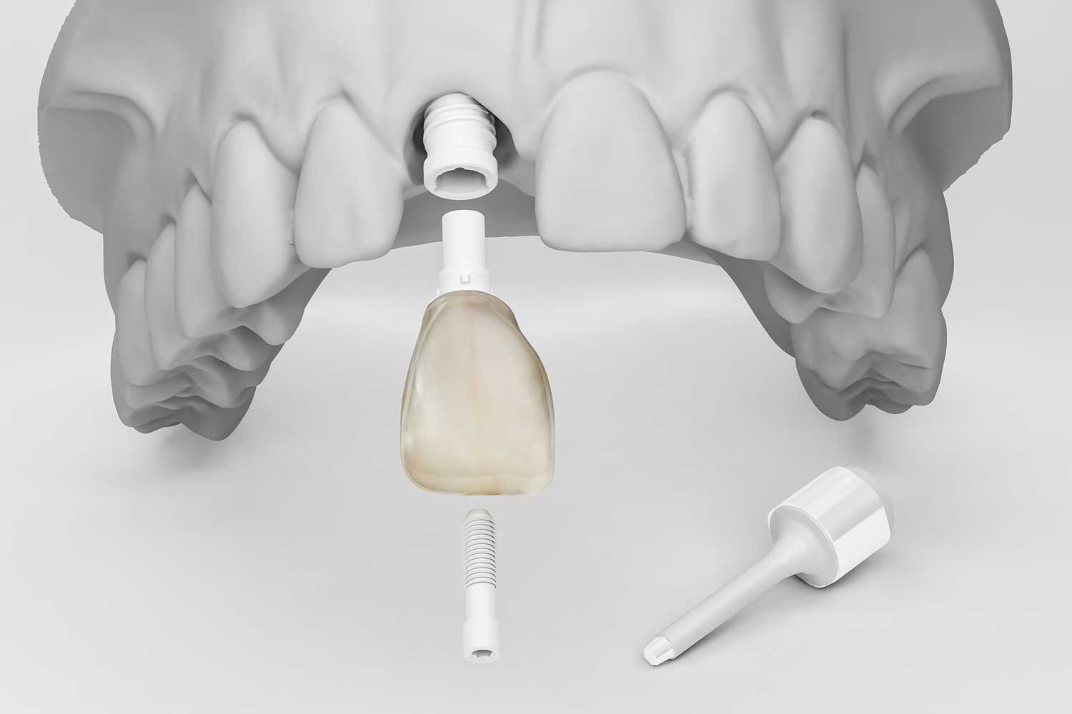 3D-Darstellung Zirkon-Implantat