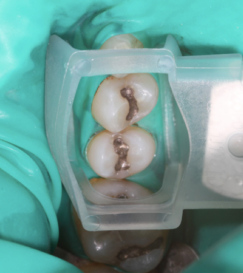 Amalganentfernung Wien & Stetten